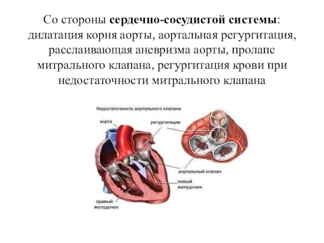 Со стороны сердечно-сосудистой системы: дилатация корня аорты, аортальная регургитация, расслаивающая аневризма аорты,