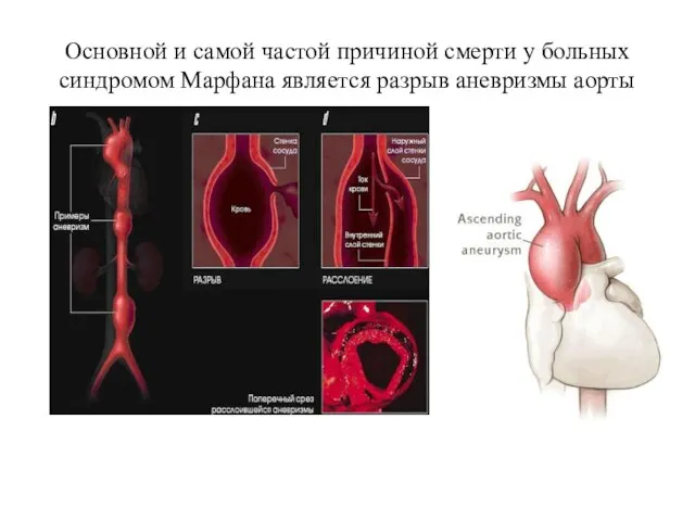 Основной и самой частой причиной смерти у больных синдромом Марфана является разрыв аневризмы аорты