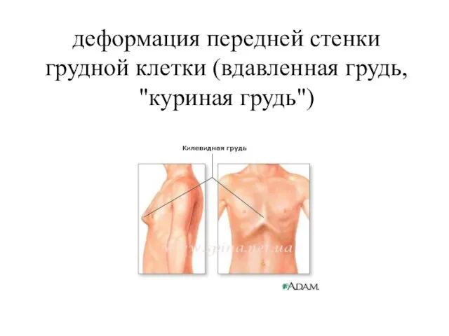 деформация передней стенки грудной клетки (вдавленная грудь, "куриная грудь")