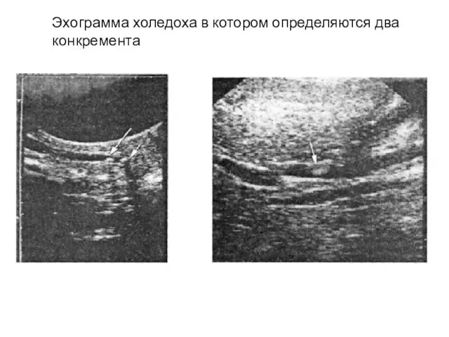 Эхограмма холедоха в котором определяются два конкремента