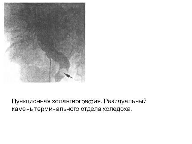 Пункционная холангиография. Резидуальный камень терминального отдела холедоха.