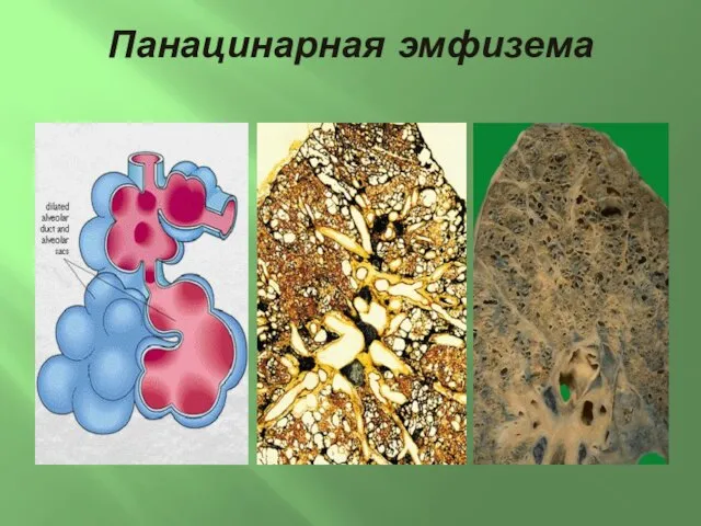 Панацинарная эмфизема