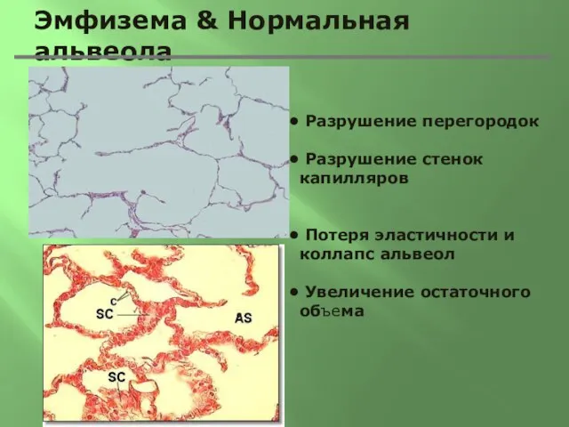 Эмфизема & Нормальная альвеола Разрушение перегородок Разрушение стенок капилляров Потеря эластичности и