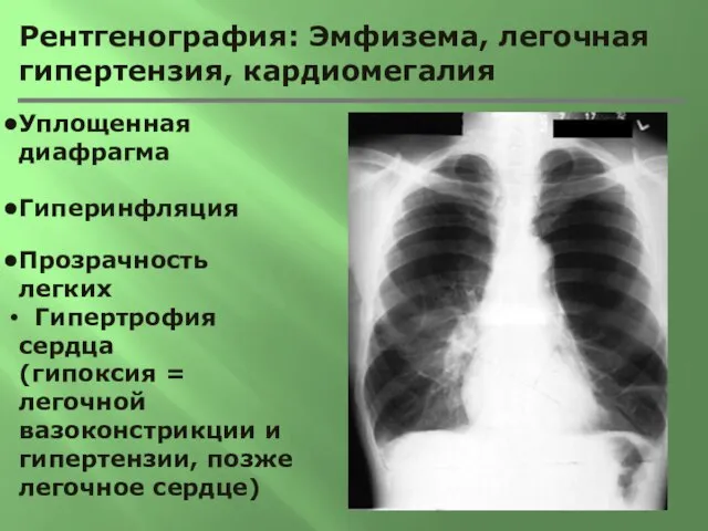 Рентгенография: Эмфизема, легочная гипертензия, кардиомегалия Уплощенная диафрагма Гиперинфляция Прозрачность легких Гипертрофия сердца