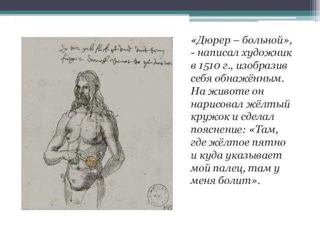 «Дюрер – больной», - написал художник в 1510 г., изобразив себя обнажённым.