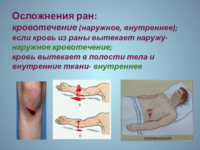 Осложнения ран: кровотечение (наружное, внутреннее); если кровь из раны вытекает наружу- наружное