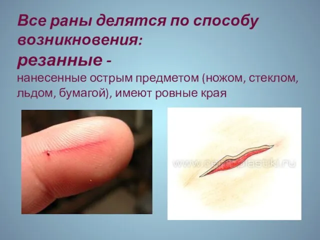 Все раны делятся по способу возникновения: резанные - нанесенные острым предметом (ножом,