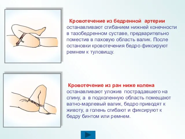 Кровотечение из бедренной артерии останавливают сгибанием нижней конечности в тазобедренном суставе, предварительно