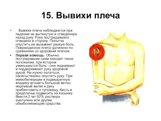 15. Вывихи плеча Вывихи плеча наблюдаются при падении на вытянутую и отведенную