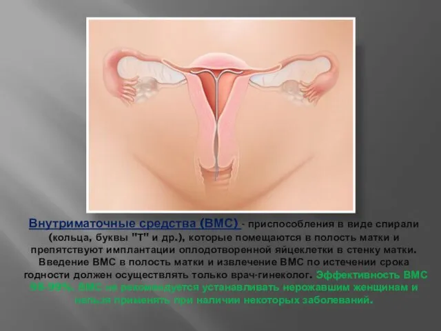 Внутриматочные средства (ВМС) - приспособления в виде спирали (кольца, буквы "Т" и