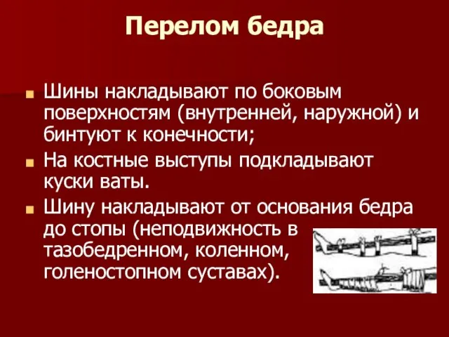 Перелом бедра Шины накладывают по боковым поверхностям (внутренней, наружной) и бинтуют к