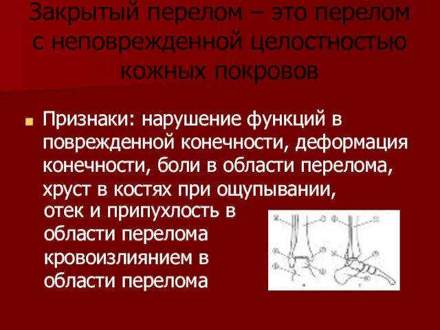 Закрытый перелом – это перелом с неповрежденной целостностью кожных покровов Признаки: нарушение