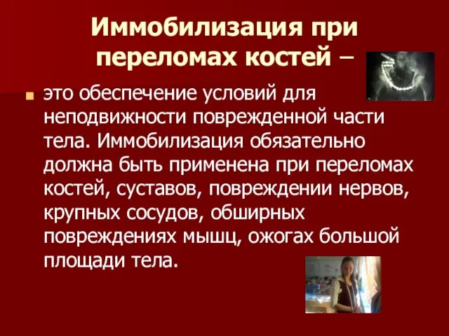 Иммобилизация при переломах костей – это обеспечение условий для неподвижности поврежденной части