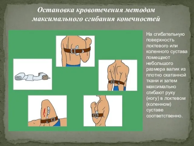 Остановка кровотечения методом максимального сгибания конечностей На сгибательную поверхность локтевого или коленного