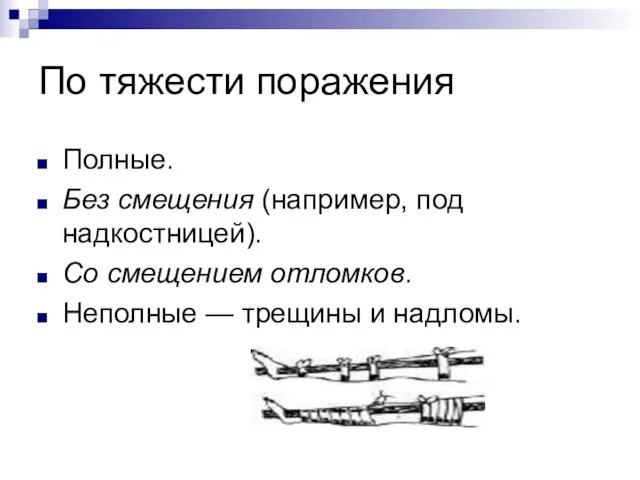 По тяжести поражения Полные. Без смещения (например, под надкостницей). Со смещением отломков.