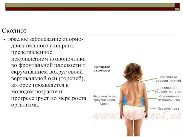 Сколиоз - тяжелое заболевание опорно-двигательного аппарата, представленное искривлением позвоночника во фронтальной плоскости