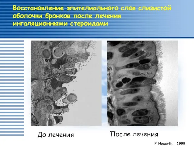 Восстановление эпителиального слоя слизистой оболочки бронхов после лечения ингаляционными стероидами P Howarth