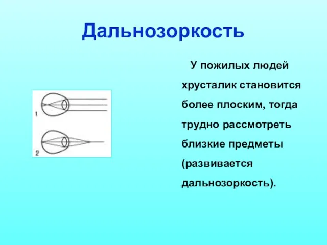 Дальнозоркость У пожилых людей хрусталик становится более плоским, тогда трудно рассмотреть близкие предметы (развивается дальнозоркость).