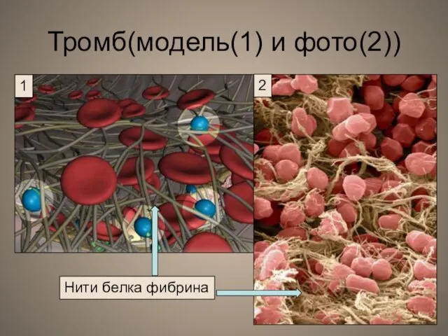 Тромб(модель(1) и фото(2)) Нити белка фибрина
