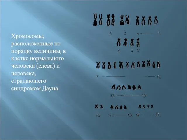 Хромосомы, расположенные по порядку величины, в клетке нормального человека (слева) и человека, страдающего синдромом Дауна