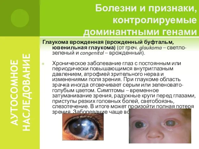 АУТОСОМНОЕ НАСЛЕДОВАНИЕ Глаукома врожденная (врожденный буфтальм, ювенильная глаукома) (от греч. glaukoma –