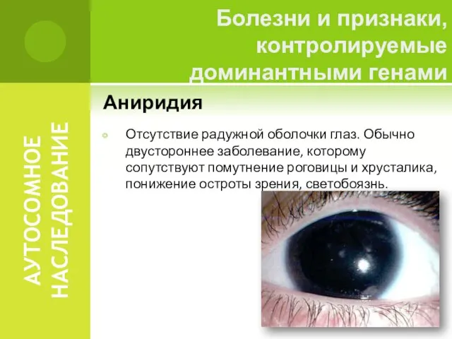 АУТОСОМНОЕ НАСЛЕДОВАНИЕ Аниридия Отсутствие радужной оболочки глаз. Обычно двустороннее заболевание, которому сопутствуют