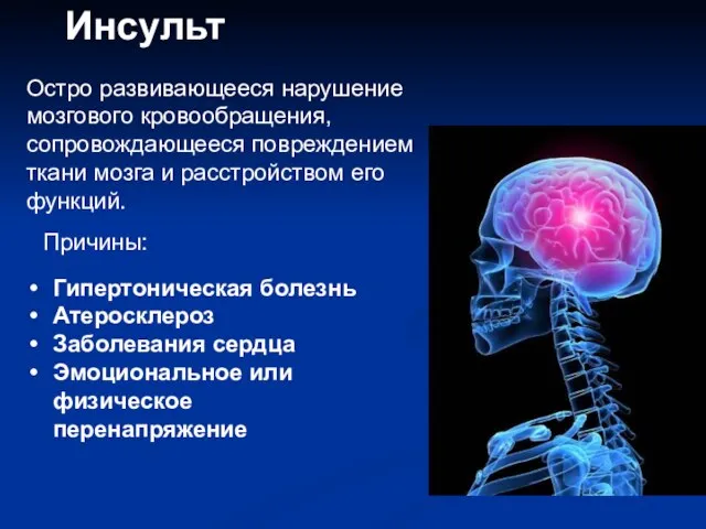 Инсульт Остро развивающееся нарушение мозгового кровообращения, сопровождающееся повреждением ткани мозга и расстройством