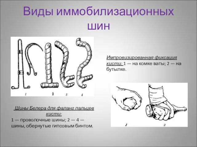 Виды иммобилизационных шин Шины Белера для фаланг пальцев кисти: 1 — проволочные