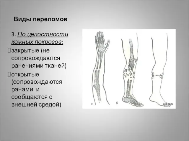 Виды переломов 3. По целостности кожных покровов: закрытые (не сопровождаются ранениями тканей)