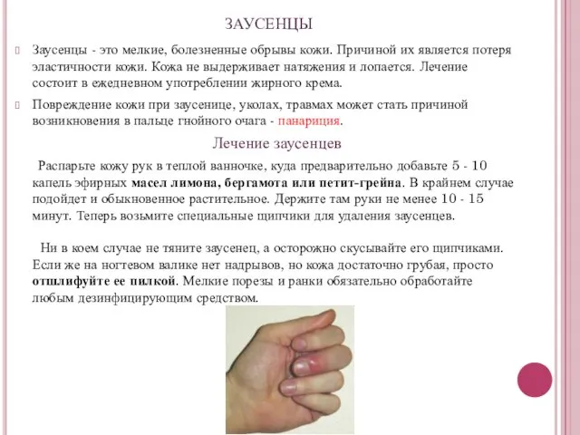 ЗАУСЕНЦЫ Заусенцы - это мелкие, болезненные обрывы кожи. Причиной их является потеря