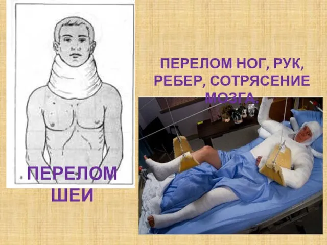 Перелом шеи Перелом ног, рук, Ребер, сотрясение мозга.