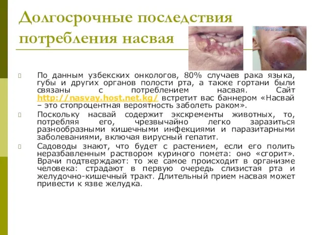 Долгосрочные последствия потребления насвая По данным узбекских онкологов, 80% случаев рака языка,