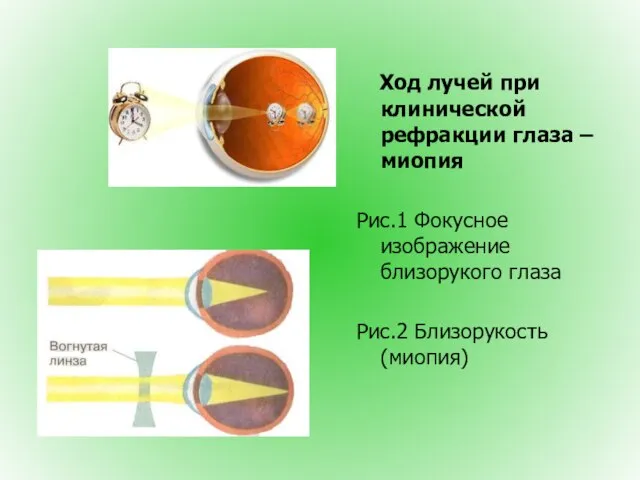 Ход лучей при клинической рефракции глаза – миопия Рис.1 Фокусное изображение близорукого глаза Рис.2 Близорукость (миопия)