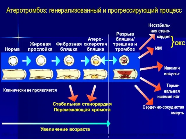 Норма Жировая прослойка Фиброзная бляшка Атеро- склеротич бляшка Разрыв бляшки/ трещина и