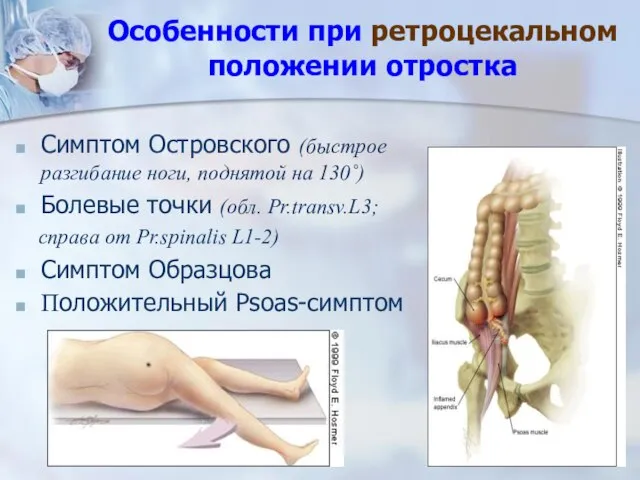 Особенности при ретроцекальном положении отростка Симптом Островского (быстрое разгибание ноги, поднятой на