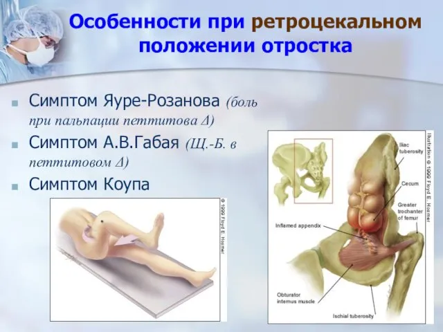 Особенности при ретроцекальном положении отростка Симптом Яуре-Розанова (боль при пальпации петтитова Δ)