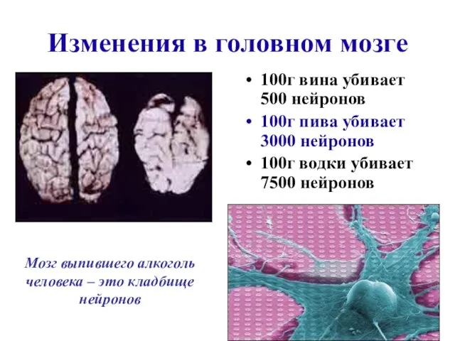 Изменения в головном мозге 100г вина убивает 500 нейронов 100г пива убивает