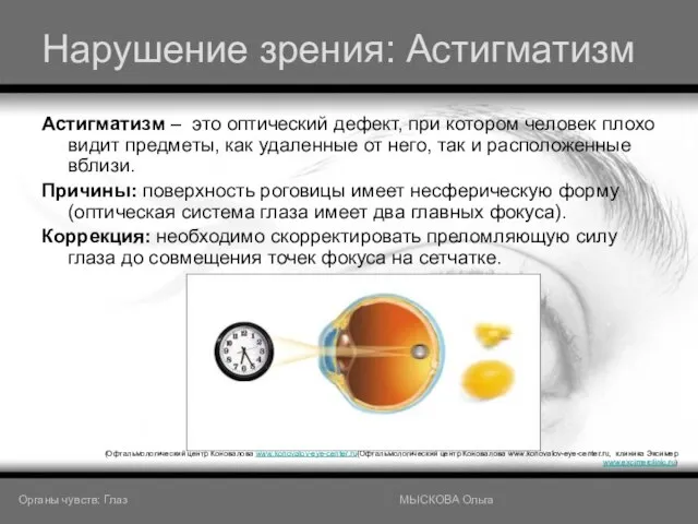 Нарушение зрения: Астигматизм Астигматизм – это оптический дефект, при котором человек плохо