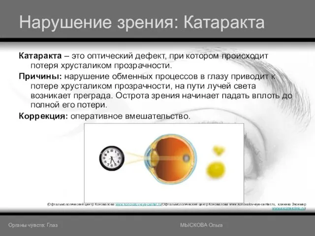 Нарушение зрения: Катаракта Катаракта – это оптический дефект, при котором происходит потеря