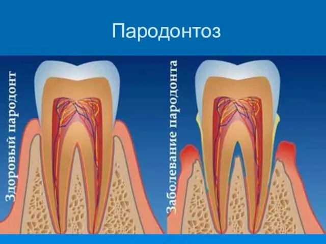 Пародонтоз