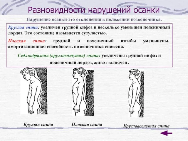 Разновидности нарушений осанки Нарушение осанки-это отклонения в положении позвоночника. Круглая спина: увеличен