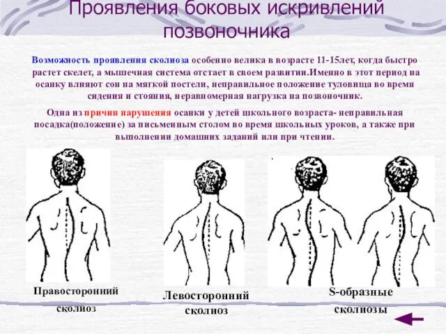 Проявления боковых искривлений позвоночника Возможность проявления сколиоза особенно велика в возрасте 11-15лет,