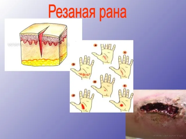 Резаная рана