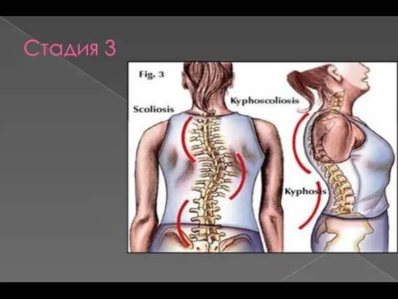 Стадия 3