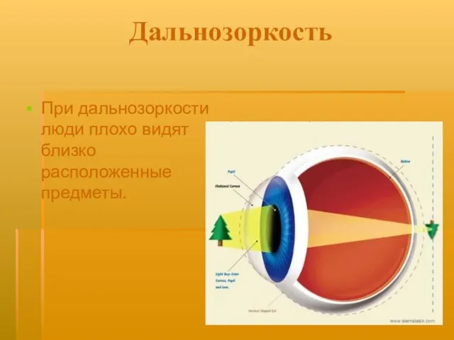 Дальнозоркость При дальнозоркости люди плохо видят близко расположенные предметы.