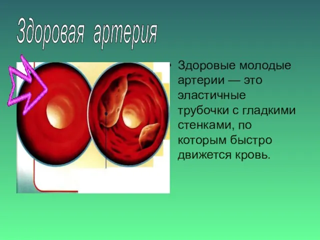 Здоровые молодые артерии — это эластичные трубочки с гладкими стенками, по которым