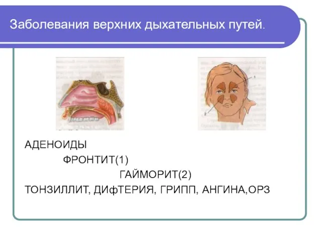 Заболевания верхних дыхательных путей. АДЕНОИДЫ ФРОНТИТ(1) ГАЙМОРИТ(2) ТОНЗИЛЛИТ, ДИфТЕРИЯ, ГРИПП, АНГИНА,ОРЗ