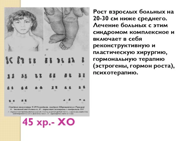 45 хр.- ХО Рост взрослых больных на 20-30 см ниже среднего. Лечение