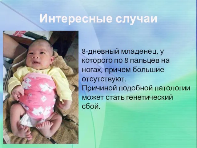 Интересные случаи 8-дневный младенец, у которого по 8 пальцев на ногах, причем