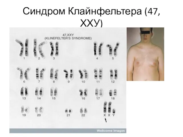 Синдром Клайнфельтера (47, ХХУ)